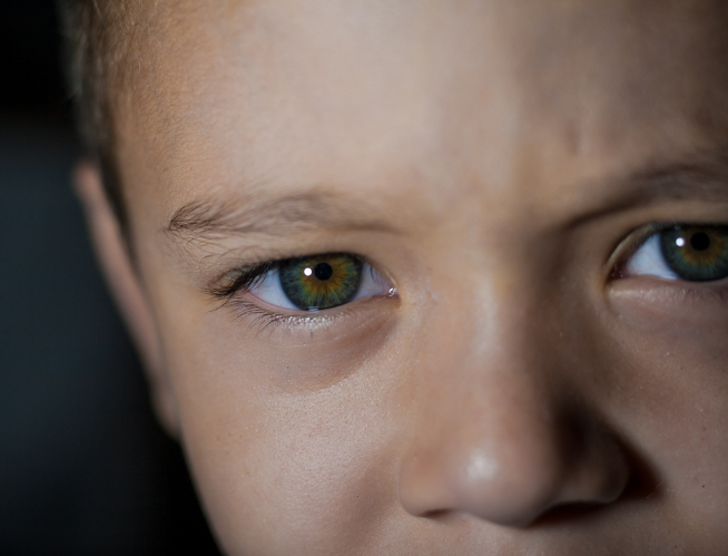 What is a Subconjunctival Hemorrhage in Children?