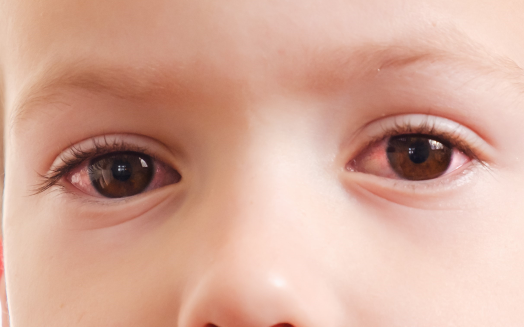 Common Pediatric Eye Infections