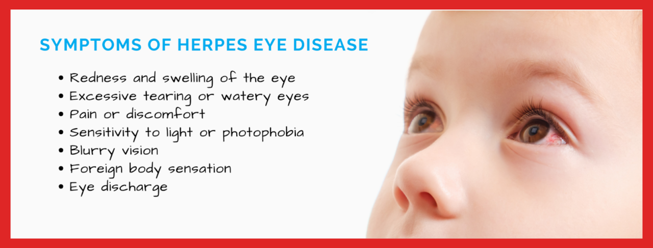 Herpes Eye Disease in Children - Pediatric Eye Associates, LLC